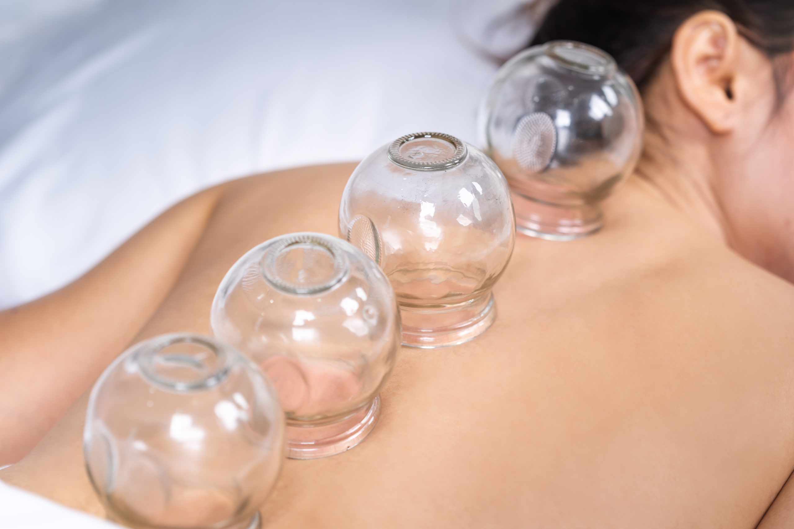 Cupping